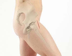 Posterior Hip Replacement