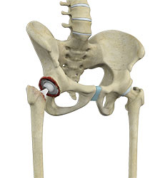 Failed Hip Replacement Correction