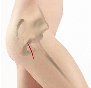 Mini-Posterior Hip Replacement