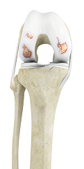 Knee Osteoarthritis