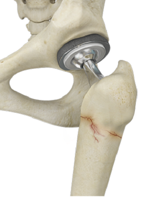 Periprosthetic Hip Fractures