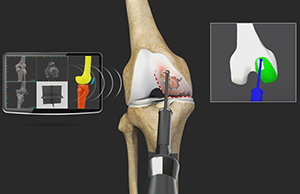 Robotic Unicondylar Knee Replacement