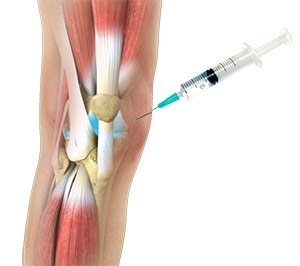 Partial Knee Resurfacing
