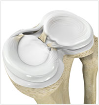 Meniscal Root Tears